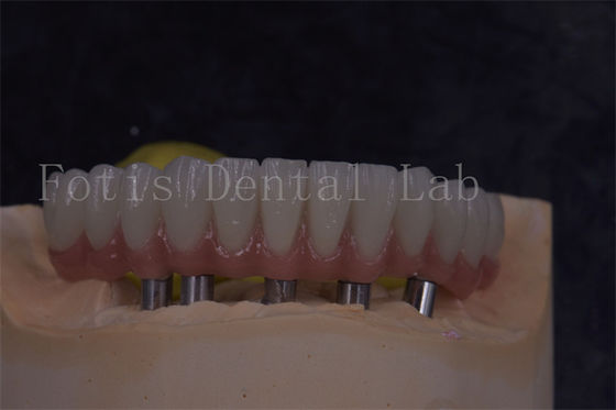 Coroas de implante dentário personalizáveis para aparência natural e restaurações confortáveis