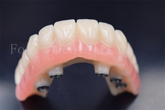 Implantes dentários personalizados Coroas de substituição Resistência ao desgaste