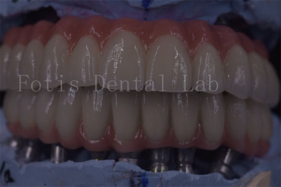Coroas de implante dentário de clínica avançada para funcionalidade superior