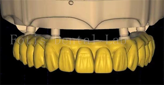 O projeto da coroa dental OEM usa tecnologia avançada de digitalização e impressão 3D