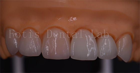 3 Formas Coroas Digitais Boa compatibilidade Dentrues Design 1 dia Entrega