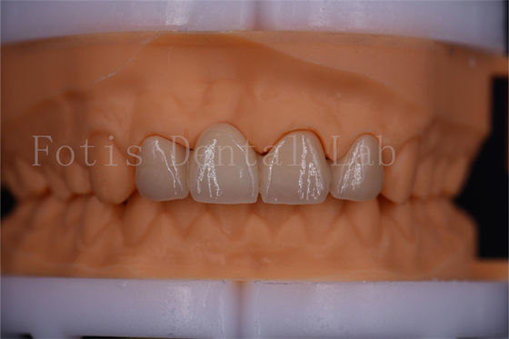 Coroas Digitais Certificadas pela FDA Design Dentrues de Ponte Dimensões Personalizáveis