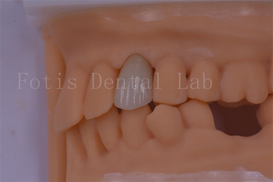 3 Forma/Exo Design Coroas Dentárias Digitais Melhor Ajuste e Menos Desconforto