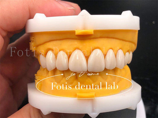 Coroas Dentárias Digitais Rápidas e Eficientes Dimensão Personalização Coroa Implante Dental