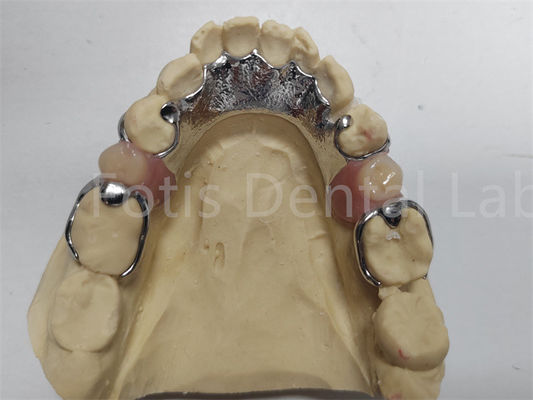 Prótese dentária parcial ajustável Prótese dentária confortável para dentes ausentes