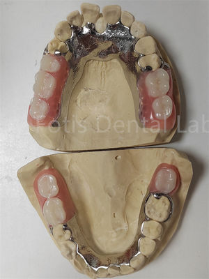 Personalização Dentes parciais temporárias compatíveis com dentes naturais