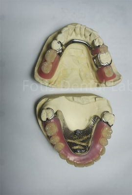 PEEK Dentadura parcial superior removível requer manutenção regular