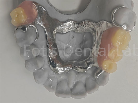 Dentadura parcial removível fácil de limpar compatível com dentes naturais