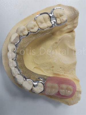 Substituir Dentes Faltantes Dentes Removíveis Parciais Prótese Dental Design Flexível