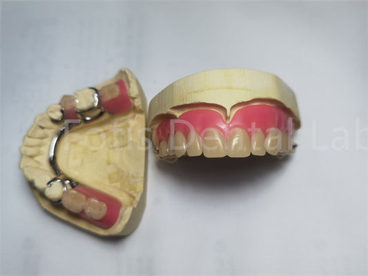 Prótese dentária parcial / prótese dentária removível personalizada
