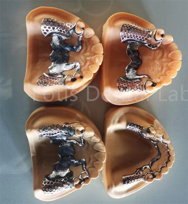 Dentadura parcial removível flexível com estabilidade duradoura e conforto ajustável