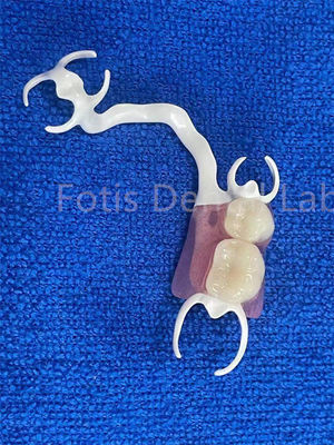 Dentadura parcial removível para substituição de dentes estáveis