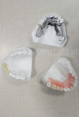 Dentadura parcial removível flexível e duradoura Facil limpeza Substitua dentes perdidos