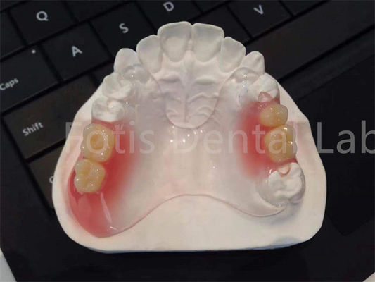 TCS flexível Valplast aparelhos dentários Confortável Design durável