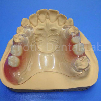 Fácil de limpar e ajustar Prótese Dental Parcial Durável Confortável