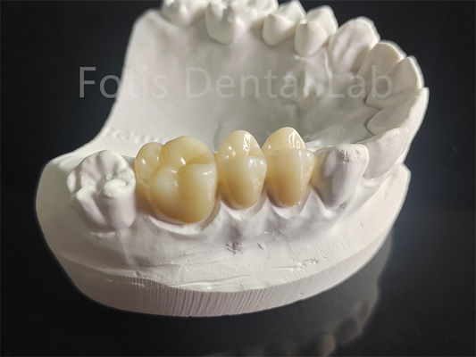 Resistente ao desgaste Zirconia revestida com material dentário de porcelana