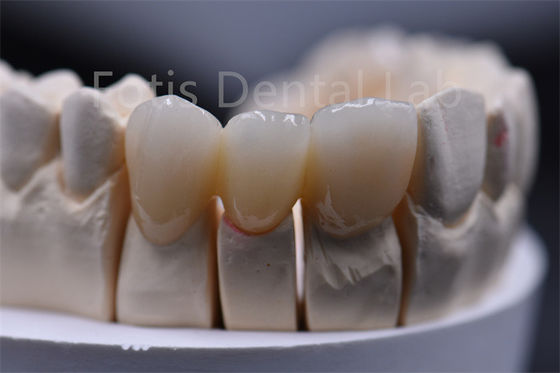 Material dentário cerâmico de zircônio de espessura personalizável