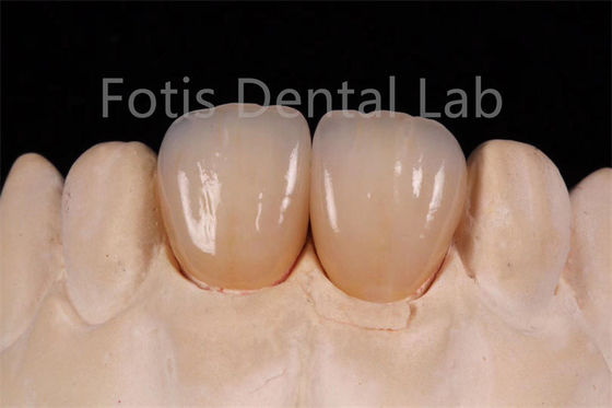 Circônio multicamadas de alta translucidez para fabricação de restaurações dentárias