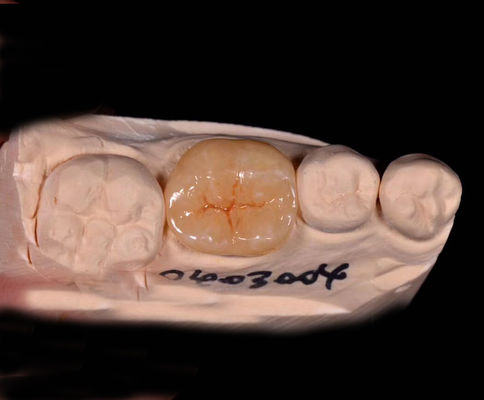 Inlays e onlays de porcelana e de porcelana, feitos sob medida, com revestimentos dentários