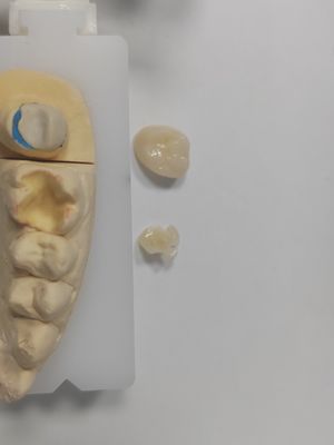 Restaurações duradouras Inlaçamento dentário Inlaçamento superior de resistência e durabilidade