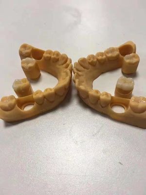 Inlays e Onlays Dentários Cerâmicos Confiáveis e Precisos