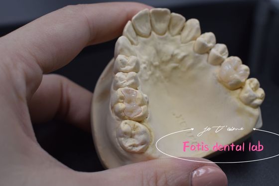 Inlay Dental Moderno e Onlay Versátil Aplicações