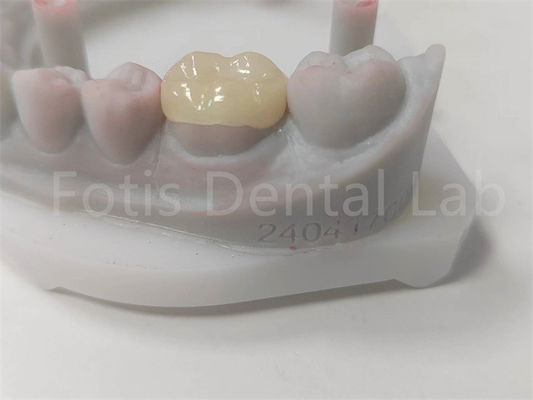 OEM Dental Inlay e Onlay Cerâmica Restauração e Dent-color de enchimento