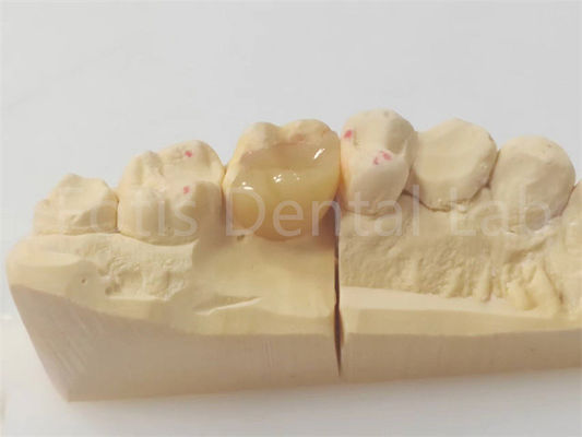 Inlay e Onlay dentários de precisão para restaurações precisas e duradouras