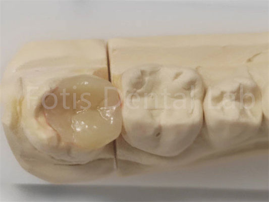 Inlação estética e onlay na odontologia para enchimento indireto e restauração de dentes