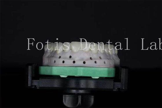 Bom preço. Veneers de laboratório dentário de alta resistência personalizáveis para sorrisos naturais on-line