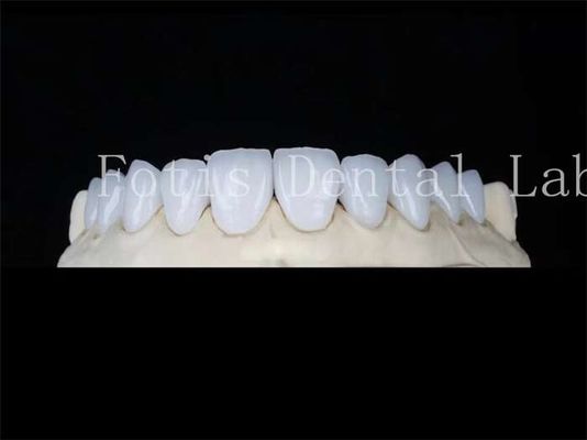 Bom preço. Veneers de porcelana natural personalizados Veneers de laboratório dentário Resistente a manchas on-line