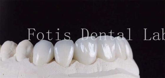 Bom preço. Folheados de laminado dentário ultra-forte translúcido cor natural on-line