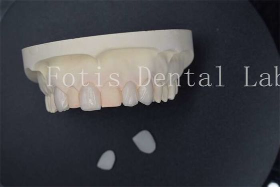 Bom preço. Veneers de laboratório dentário artificiais personalizados com resistência superior às manchas on-line