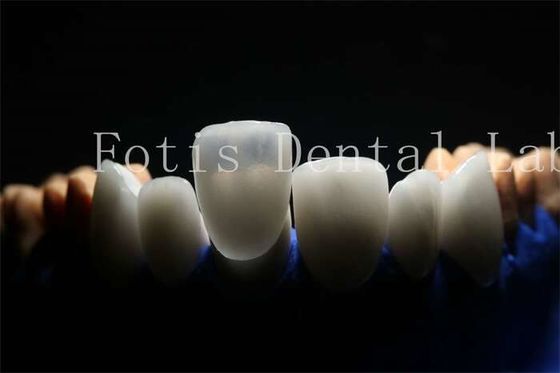 Folheados protésicos laminados com material de porcelana, duráveis e duráveis