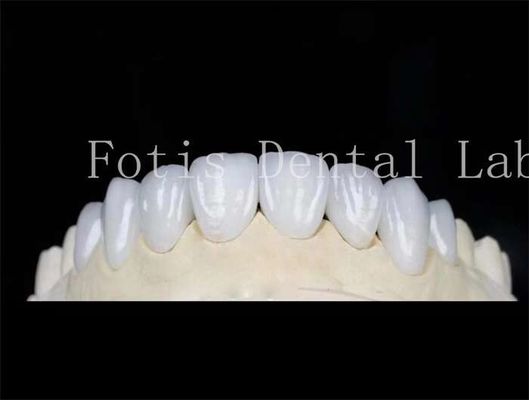 Bom preço. Laminado Dental de Cor Natural Veneers Dentes Falsos Veneers Com Cimento de Ligação on-line