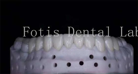 Bom preço. OEM ODM Resistente a manchas Veneers de porcelana de aparência natural Alta resistência on-line