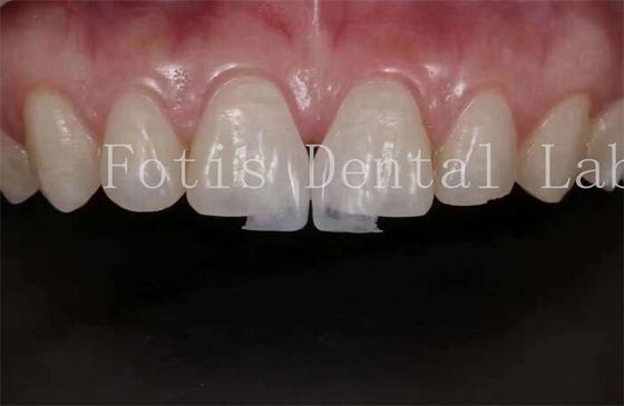 Folheados laminados de laboratório dentário de alta translucidez para polimento e polir