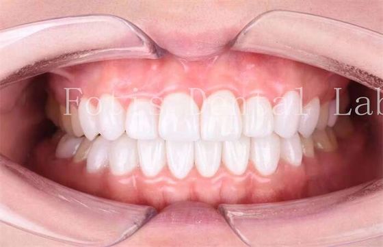 Bom preço. Laminado Dental de Alta Translucidez Veneers Durabilidade Durabilidade Polido acabamento on-line