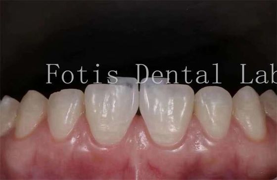 Bom preço. Poluição de folhas de laminado dentário sintético Alta resistência às manchas on-line
