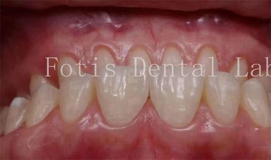 Bom preço. 0.3-0.5mm espessura Dentes cosméticos cobre folheados para odontologia cosmética on-line