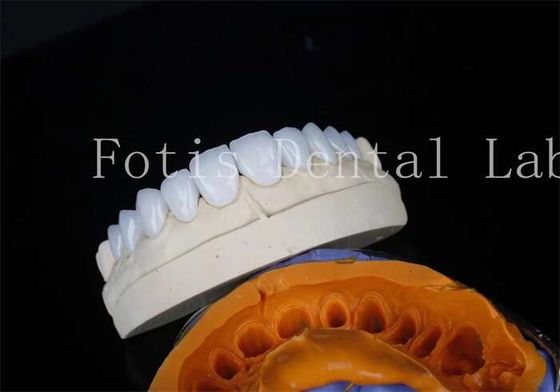 Bom preço. Porcelana de laboratório de odontologia veneers cimento de ligação para restaurações duradouras on-line