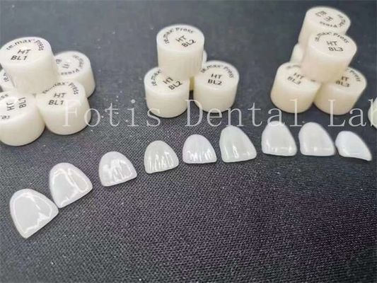 Fabricação personalizada de folheados de laboratório dentário laminados com alta resistência e resistência a manchas