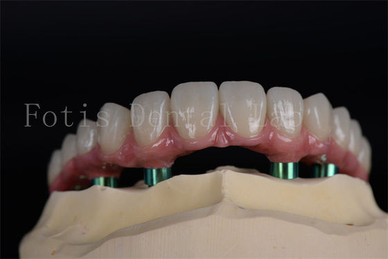 Duração longa Todos em 4 Todos em 6 Implantes Aparência natural Estética Sem limite de idade Recuperação