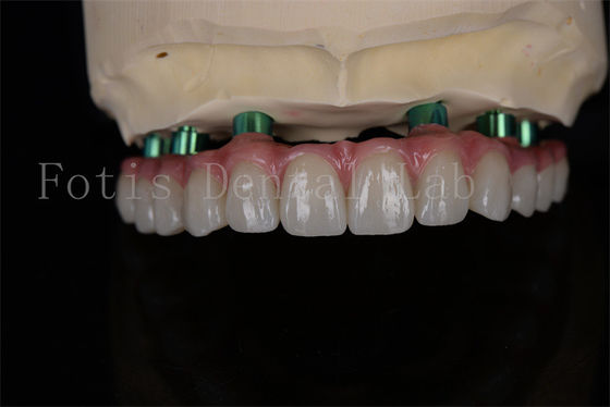 Procedimento de implante Zirconia All-on-4 no mesmo dia Recuperação Mínimo acompanhamento necessário