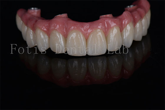 Implantes Dentários All on 4 All on 6 de longa duração, minimamente invasivos e de fácil manutenção para necessidades de baixa densidade óssea