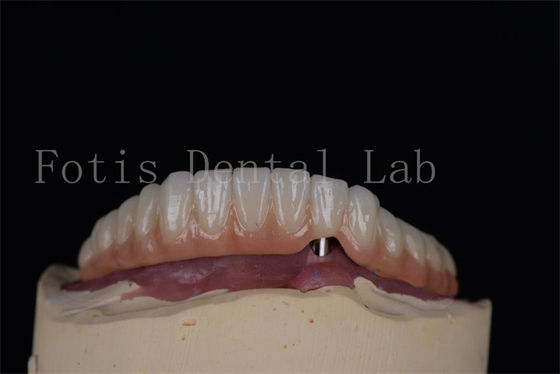Implantes dentários de titânio ou zircônio de aparência natural Procedimento minimamente invasivo Fácil de limpar