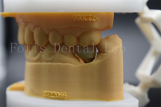 Bom preço. Coroas de laboratório dentárias polidas de longa duração on-line