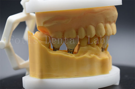 Bom preço. Coroa dental de titânio de precisão para implante dental fácil de limpar e manter on-line