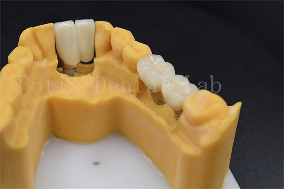 Bom preço. Restauração dental personalizável Implante Substituição de coroa Vários tamanhos on-line