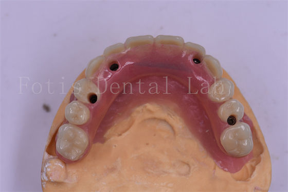 Bom preço. Implante Dental Titânio Coroa Dental Precision Fit Design Personalizado on-line